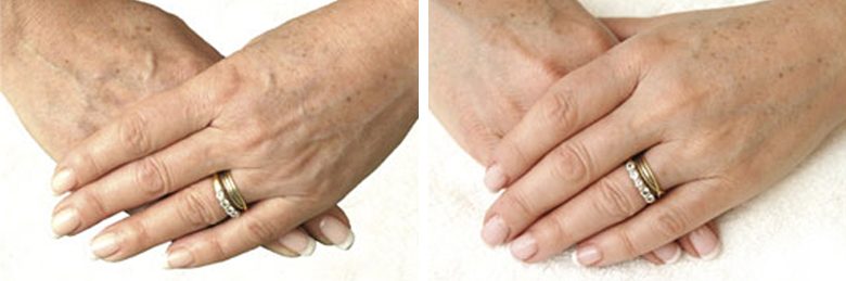 Hands before and after dermal fillers