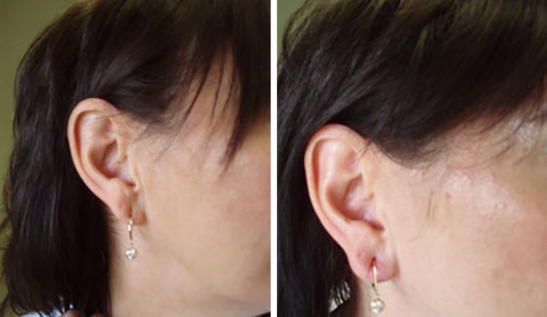 before and after ear lobe reconturing
