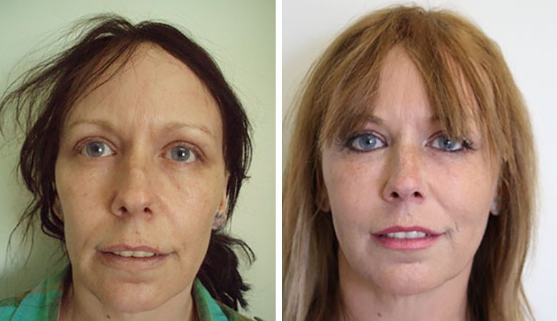 before and after facial reconturing