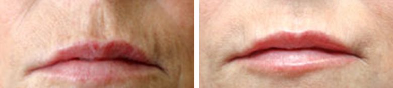 dermal fillers section lips before and after