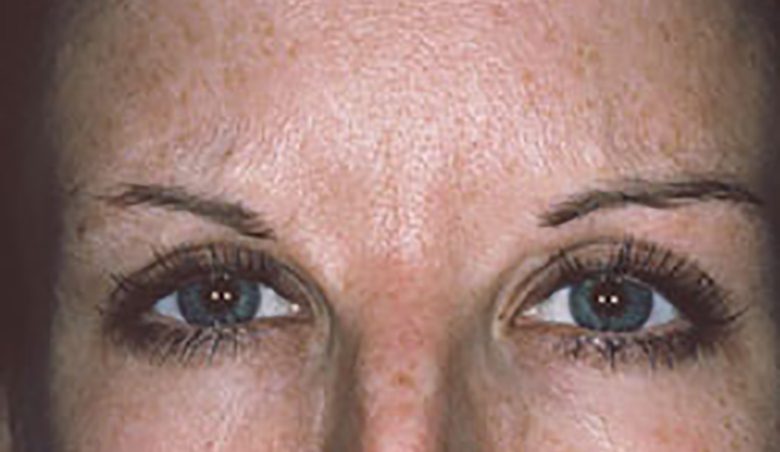 frown line after botox section