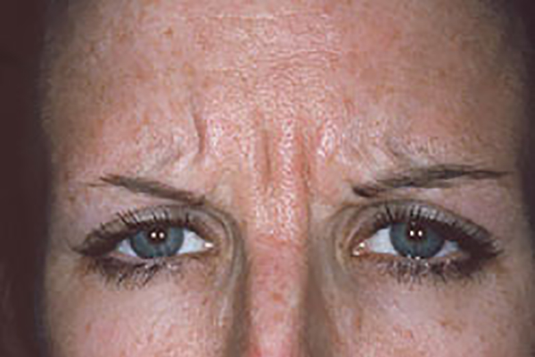 frown lines before botox section