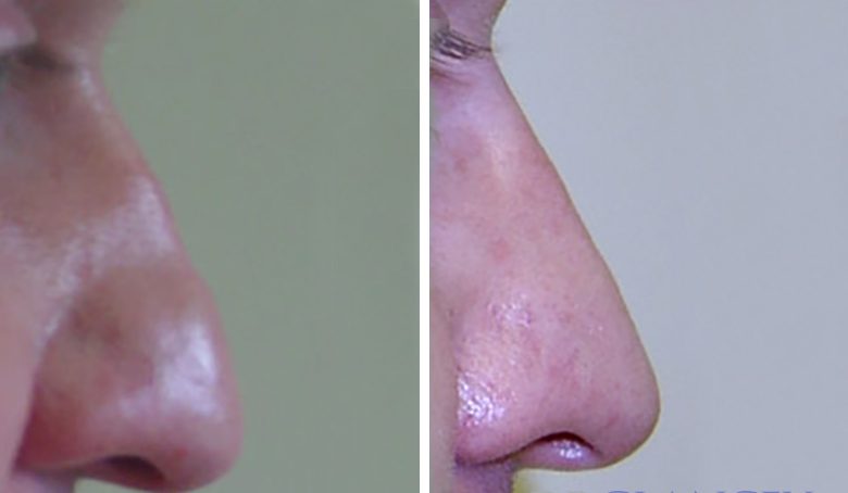 nose before and after reconturing section