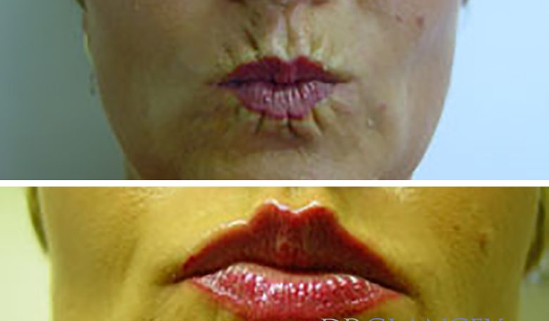 smokers line before and after botox section
