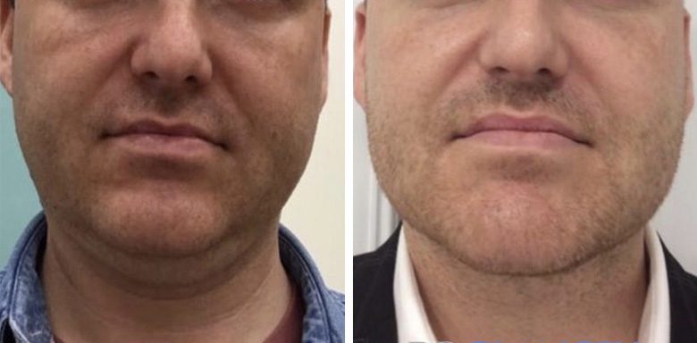 FacetiteImage