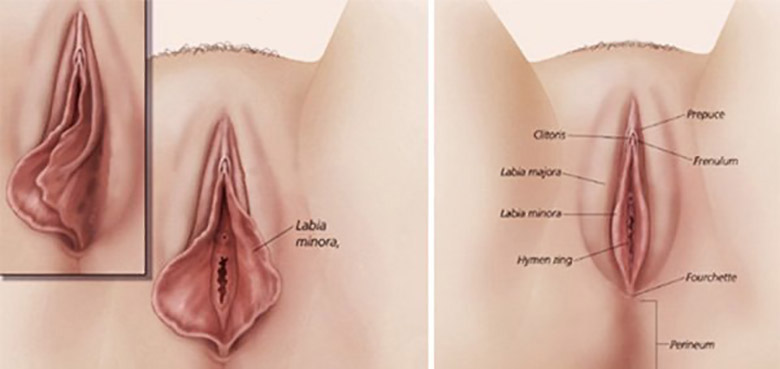 Labiaplasty