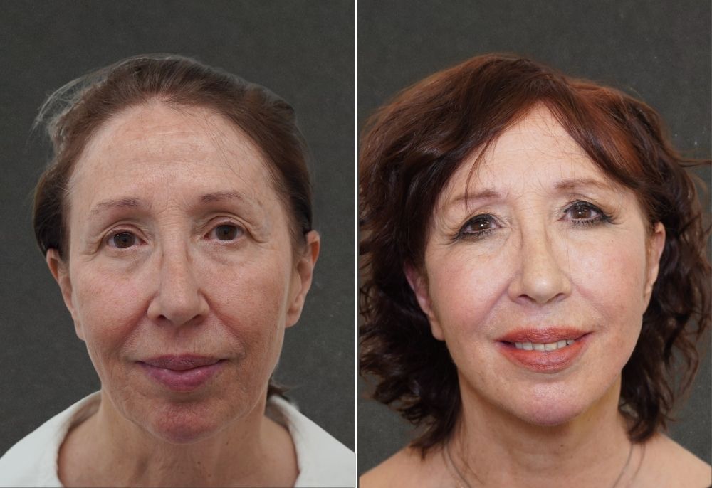 Spring Thread&reg; lift before and after result 1