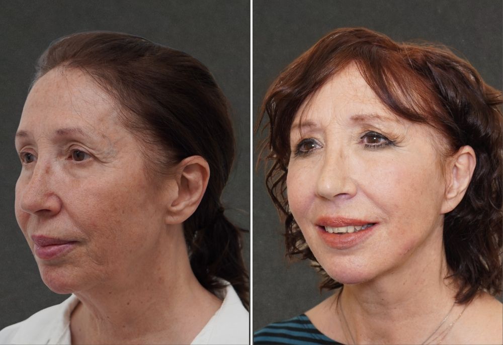 Spring Thread&reg; lift before and after result 2