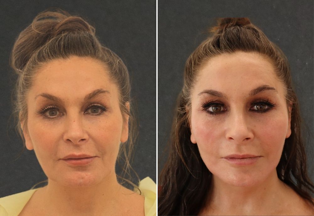 Spring Thread&reg; lift before and after result 3