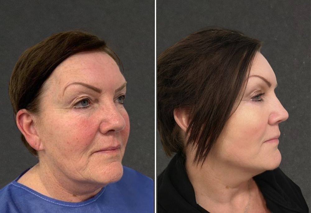 Spring Thread&reg; lift before and after result 4
