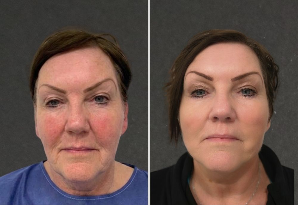 Spring Thread&reg; lift before and after result 5