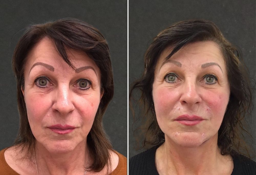 Spring Thread&reg; lift before and after result 6